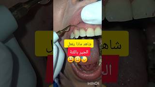 جير الاسنان سبب التهاب لثة شديد dentist stitch اكسبلور stitchfan ترند stitchlover dentistry [upl. by Aleacem162]