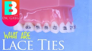 Lace Ties for Braces [upl. by Wack131]