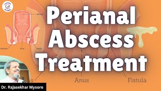 Perianal Abscess Treatment  Dr Rajasekhar Mysore  Chirag Global Hospitals [upl. by Yliah]