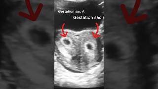 6 Weeks Pregnant with Bicornuate Uterus Ultrasound Scan [upl. by Bowie143]