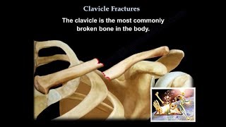 Clavicle Fractures  Everything You Need To Know  Dr Nabil Ebraheim [upl. by Oscar]