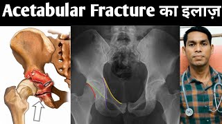 acetabular fracture treatment in hindi hip bone fracture pelvic fracture ka ilaj  acetabulum [upl. by Endora897]