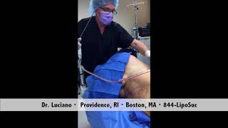 Vaser Liposuction amp Vaser Smooth Cellulite Surgery by Dr Luciano [upl. by Jenkel]