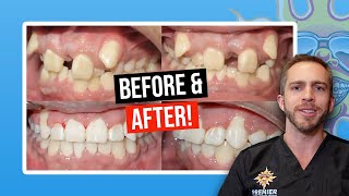 Invisalign before and after [upl. by Samoht208]