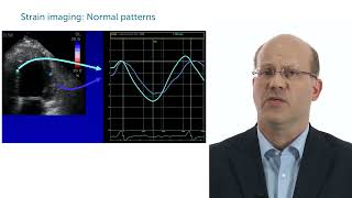 Case Strange wall motion abnormality that is not an infarct [upl. by Garges]