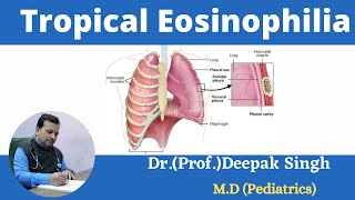 Tropical Eosinophilia  Eosinophilic Lungs  Eosinophilia  Deepak PD Singh [upl. by Kinch16]