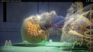 3D Medical Video HD  Cerebral Aneurysm Coiling [upl. by Llen803]