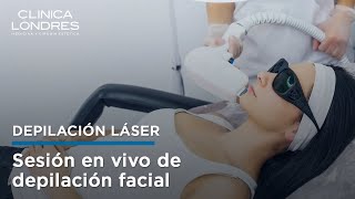 Depilación láser facial sesión con paciente real [upl. by Neils]