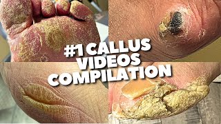 Super Crusty Callus Removal Compilation So Satisfying [upl. by Mohsen]