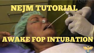 Awake Fiberoptic intubation methods indications Howto demonstration in Switzerland  NEJM  4K [upl. by Nnaitsirhc]