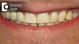 Can one whiten the teeth if having Dental Fluorosis  Dr Aniruddha KB [upl. by Yamauchi]