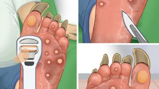 ASMR animation foot wart treatment toenail careRemove thick dead skin cells and calluses [upl. by Ayor605]