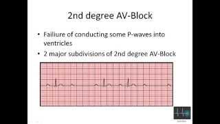 ECG cardiac arrhythmias [upl. by Acinyt]