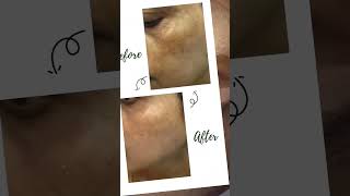 Cosmelan Peel Treatment [upl. by Ecydnarb]