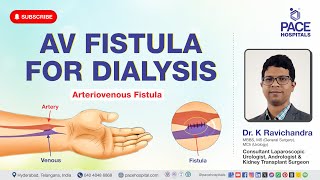 AV Fistula Surgery  AV Fistula for Dialysis  Procedure Uses Benefits amp Complications [upl. by Ahsekim817]