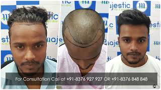 Receding Hairline  Most Natural Hairline Design amp Hair Transplant Results [upl. by Truk940]