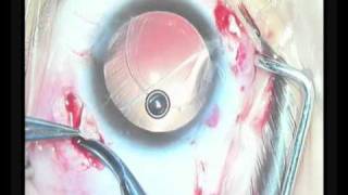 scleral fixation of foldable IOL in the sulcus above the decentered bag [upl. by Griz652]