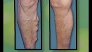 Varicose Vein Treatment by Laser  Endovenous Saphenous Vein Ablation  ELVES [upl. by Emerej]