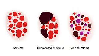 Angiomas and variants  Dr C Navarrete Dechent [upl. by Leoni]