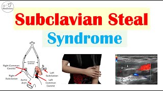 Subclavian Steal Syndrome “Stealing Blood From Brain” Risk Factors Symptoms Diagnosis Treatment [upl. by Lehmann]