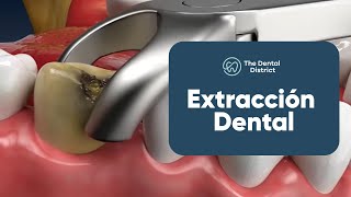 Retira una Muela del Juicio con una Extracción Dental  The Dental District [upl. by Enelia]