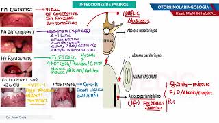 Otorrinolaringología  Infecciones de faringe [upl. by Pietrek109]