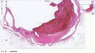 Atheromatous Plaque with Thrombosis  Histopathology [upl. by Lemrej495]