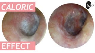 Caloric Effect Observed During Ear Wax Removal  366 [upl. by Dambro366]