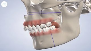 TMJ Treatment in Modesto CA  Greater Modesto Dental Implant amp Oral Surgery Center [upl. by Eniamrahc]