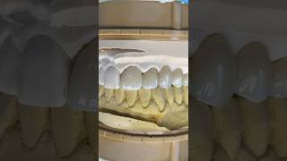 Splinted Pontic Bridge dental teeth dental smile lsk121shorts shortvideo shorts [upl. by Jillana]