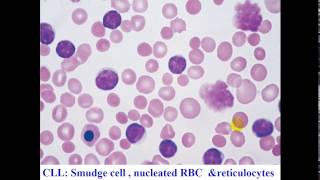 Pathology  dr Nafea  Non Hodgkin lymphomas أورام [upl. by Nnovahs851]