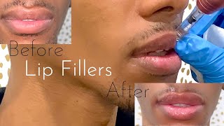 HYALURON PEN LIP FILLERS  BEFORE AND AFTER NEEDLELESS INJECTIONS0 [upl. by Nuyh]