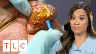 Dr Lee Transforms Patients Hugely Overgrown Nose I Dr Pimple Popper Pop Ups [upl. by Rufena]