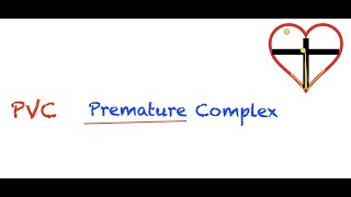 Premature Ventricular Contractions PVC Interpretation Easy and Simple [upl. by Atalee86]