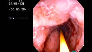 Colitis Ulcerativa Crónica Inespecífica CUCI [upl. by Avek832]