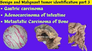 Gastric carcinoma Adenocarcinoma of Intestine Metastatic tumor of Bone identification Patho OSPE [upl. by Htir]