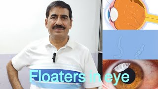 Floaters in eye and their treatment [upl. by Hime656]