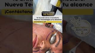 Láser para Cicatriz de Acné acne laseracne acnescars [upl. by Yorker]