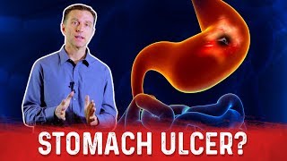 How To Get Rid Of Stomach Ulcer – DrBerg On Peptic Ulcer Treatment [upl. by Zehc]