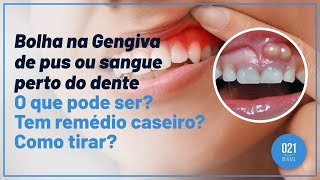 Bolha na Gengiva de pus ou sangue perto do dente O que pode ser Tem remédio caseiro Como tirar [upl. by Reidar880]