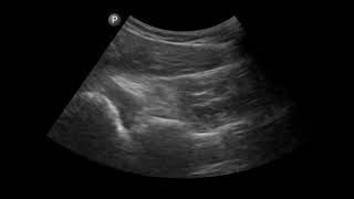 Shoulder Ultrasound Glenohumeral Joint Arthrocentesis [upl. by Annamarie666]