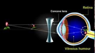 Short vs Long Sight Myopia vs Hypermetropia in 100 seconds [upl. by Hadeehsar]