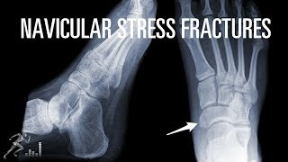 How can you quickly recover from a navicular stress fracture [upl. by Auhesoj660]