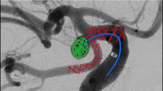 Deutsch Aneurysma der Arteria communicans posterior PCOM stentassistierte Coilembolisation [upl. by Irreg]