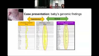 “Takes a village to manage a rare case of maternofetal transmission of malignancy” Grand Rounds [upl. by Ocnarfnaig133]