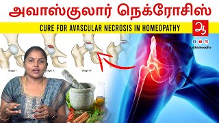 ரத்தஓட்டம் தடைபடுவதால் வரும் Avascular necrosis loss of blood supply to bone Avascular necrosis AVN [upl. by Mirielle]