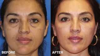 Facial Plastic Surgeon Explains How to Take 10 Years off your Eyes With Surgery blepharoplasty [upl. by Ynoyrb]