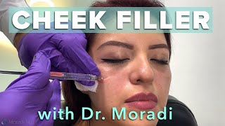 Watch This Patient Get Cheek Filler Before amp After Restylane Contour [upl. by Swiercz]