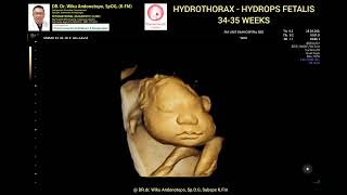 Hydrothorax  Hydrops fetalis 3435 weeks [upl. by Yemrots]