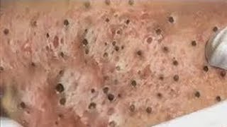 How To Remove Blackheads And Whiteheads On Face Easy 88 ✦ Dr Laelia ✦ [upl. by Erdnael]